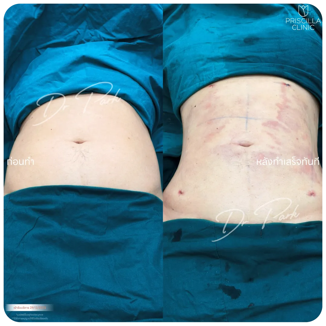 ดูดไขมัน-01_result