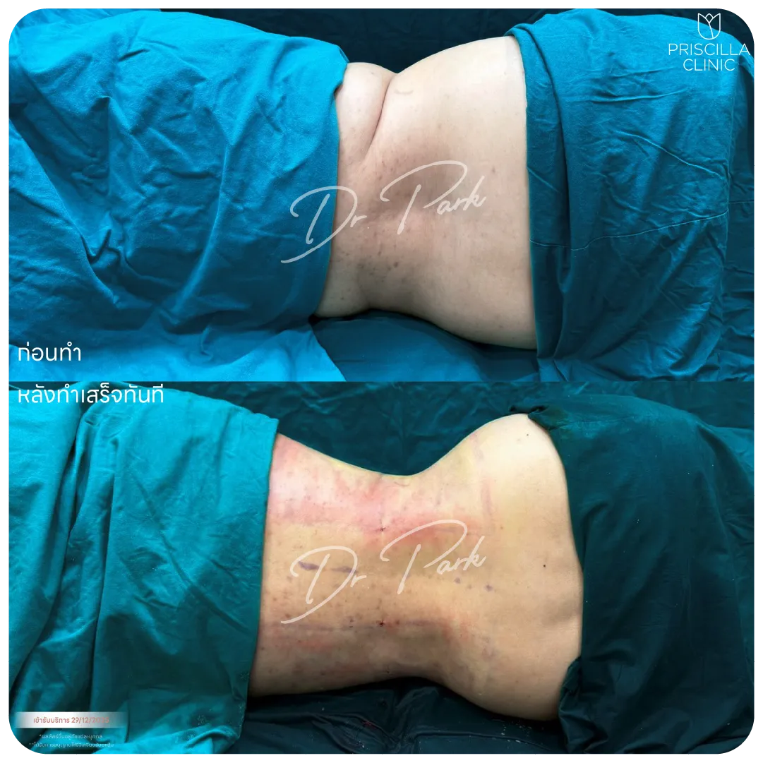 ดูดไขมัน-02_result_1