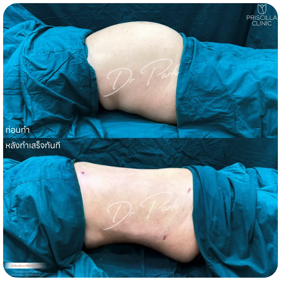 ดูดไขมัน-03_result