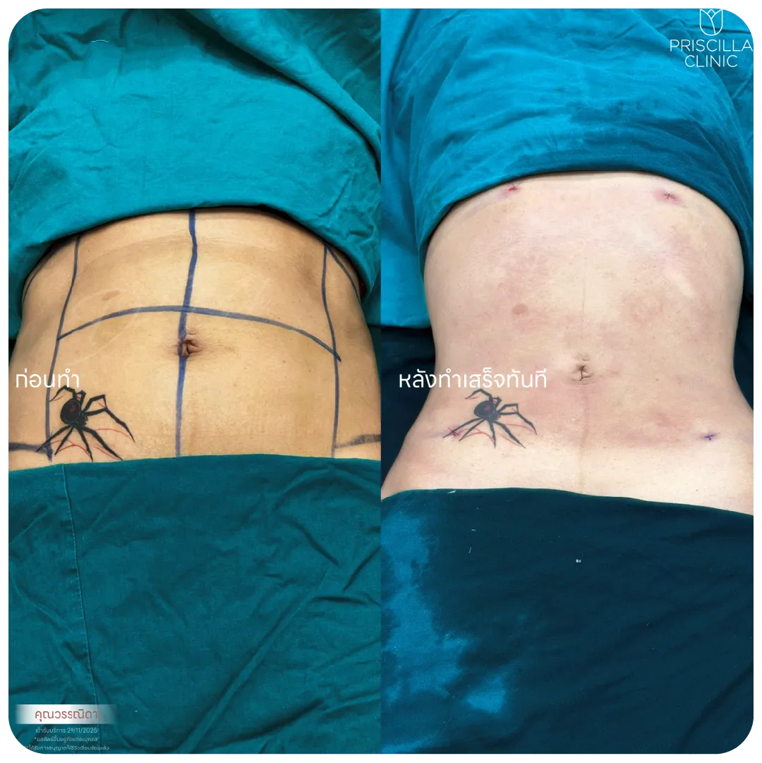 ดูดไขมัน-04_result