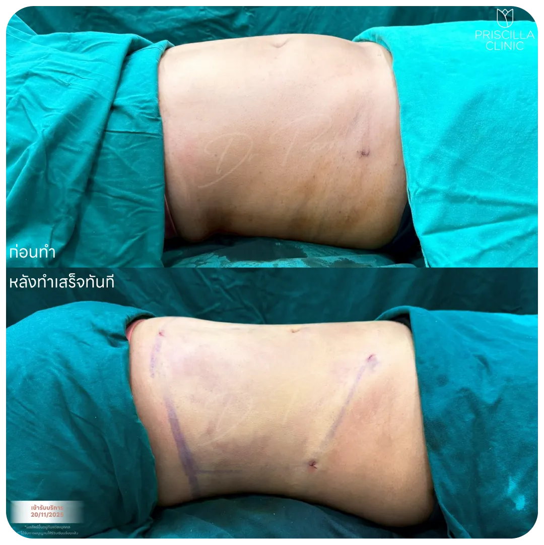 ดูดไขมัน-05_result