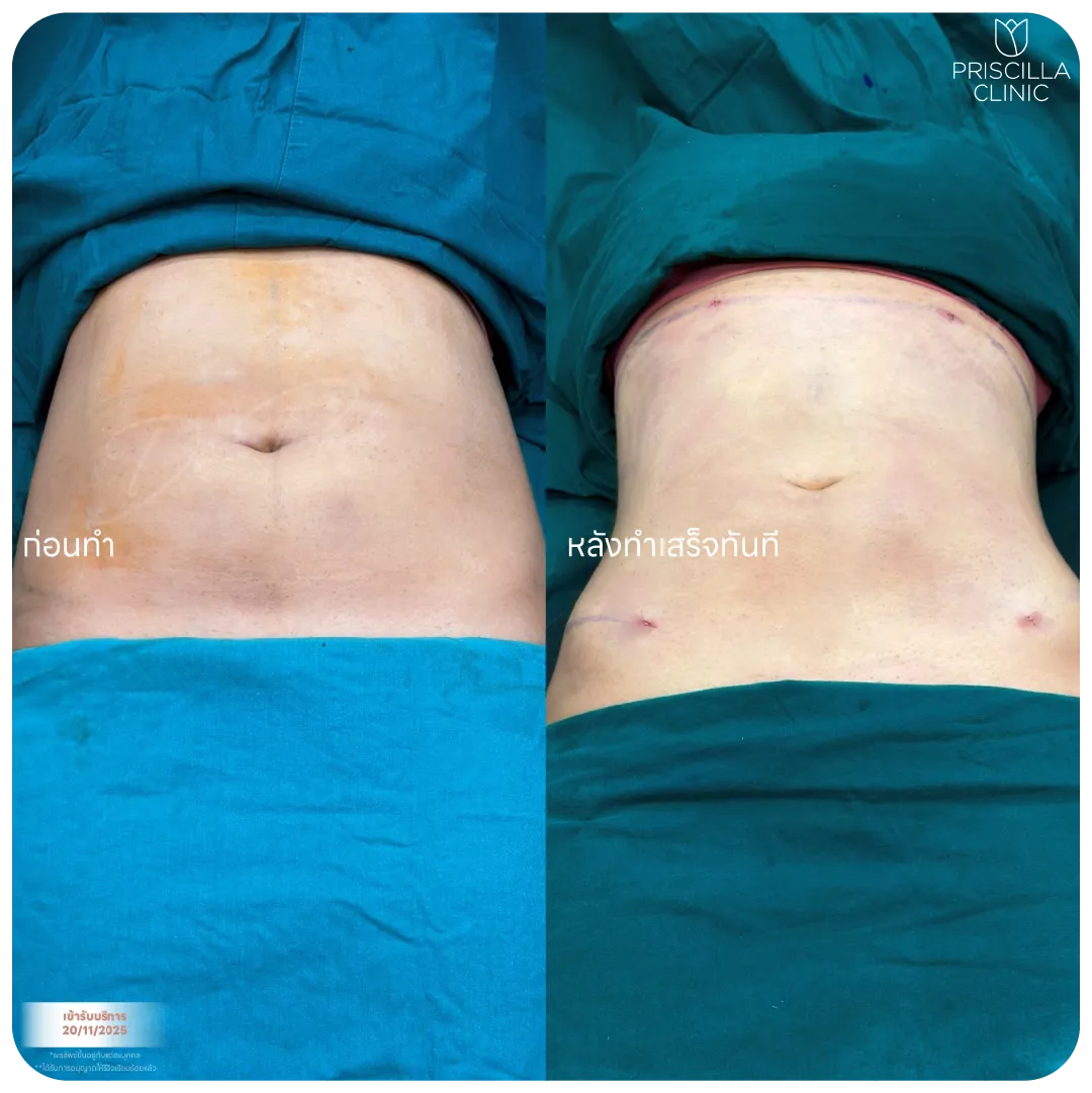 ดูดไขมัน-06_result