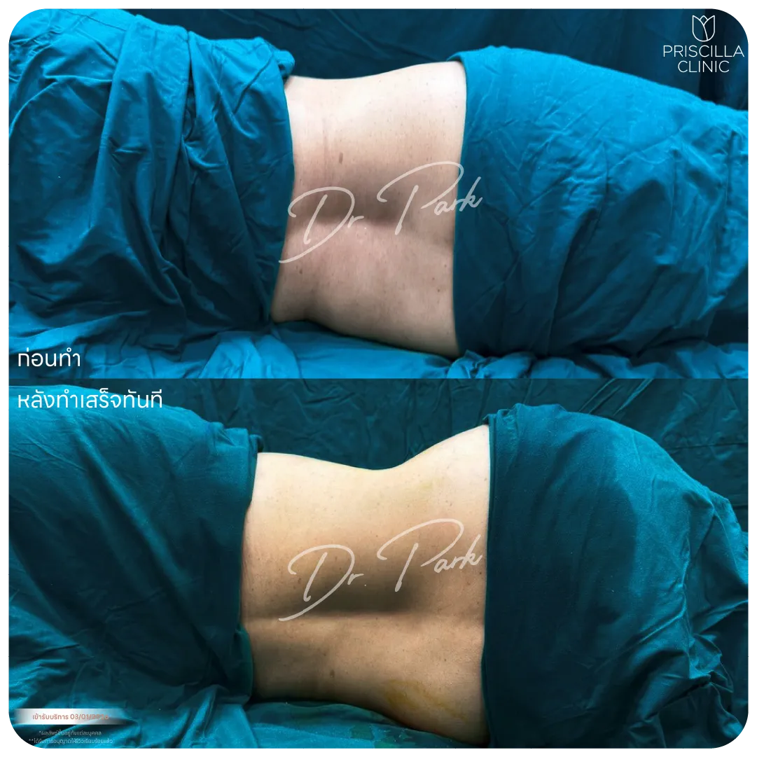 ดูดไขมัน-07_result