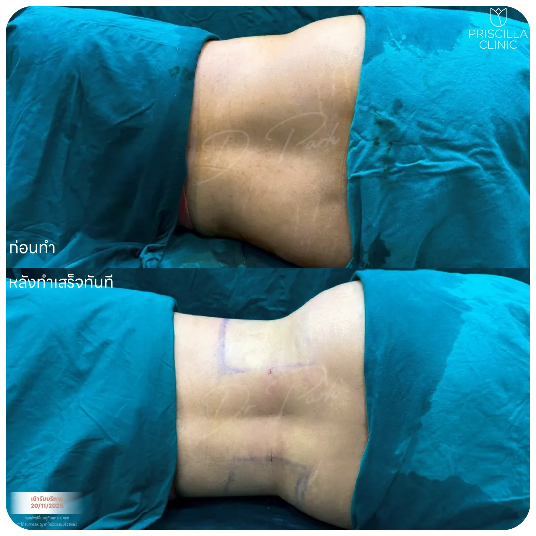 ดูดไขมัน-08_result