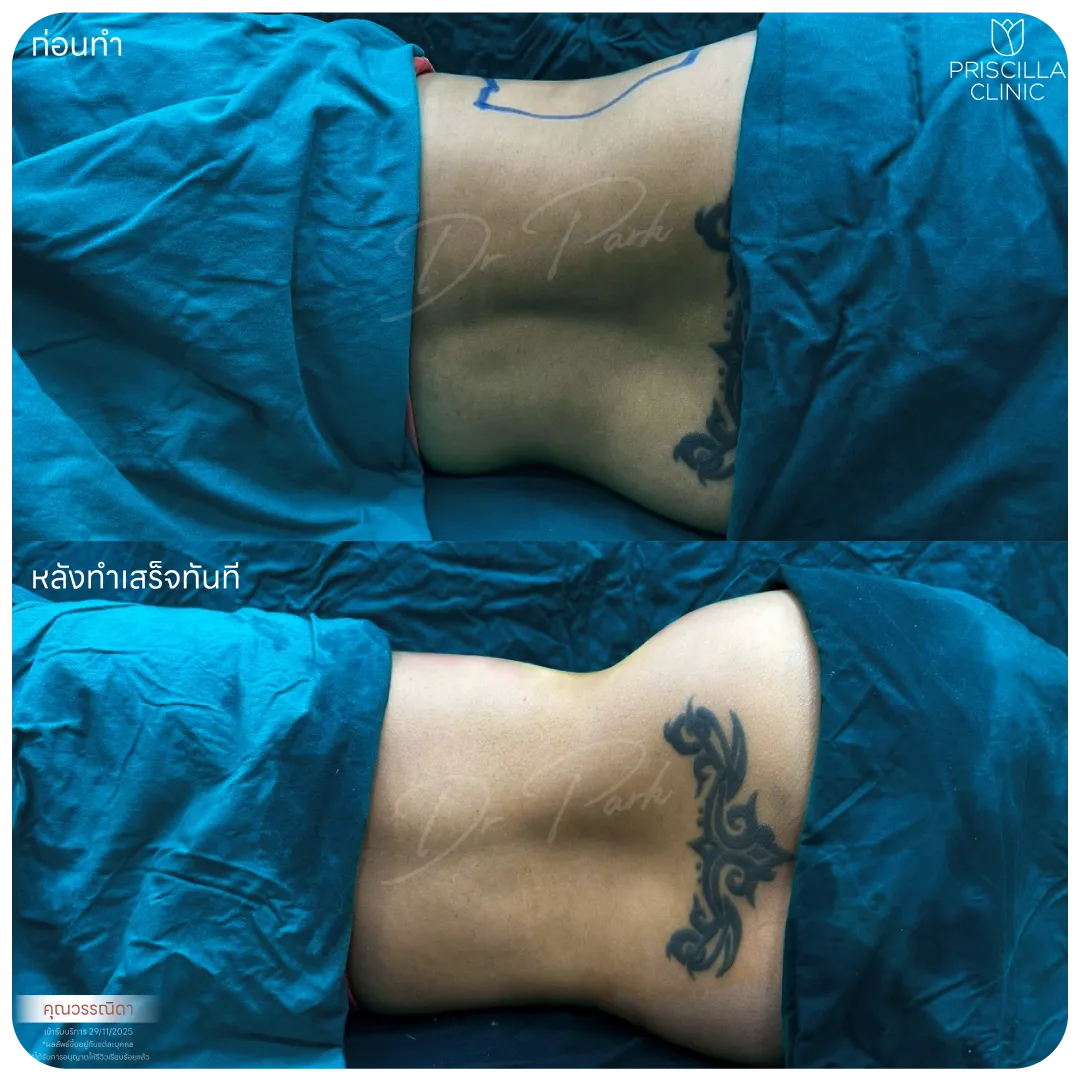 ดูดไขมัน-09_result