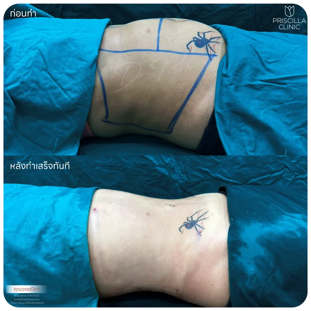 ดูดไขมัน-10_result