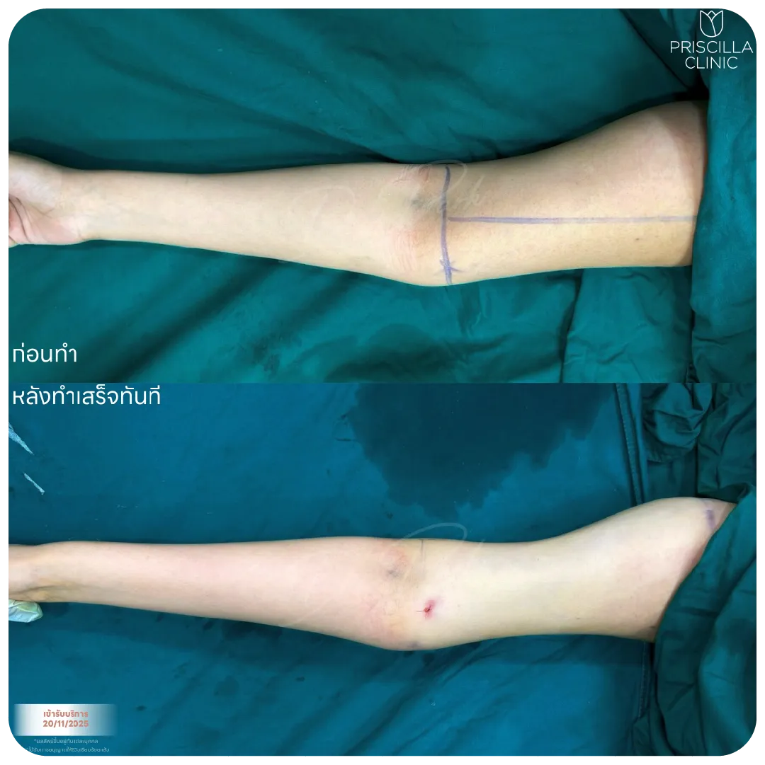 ดูดไขมัน-12_result