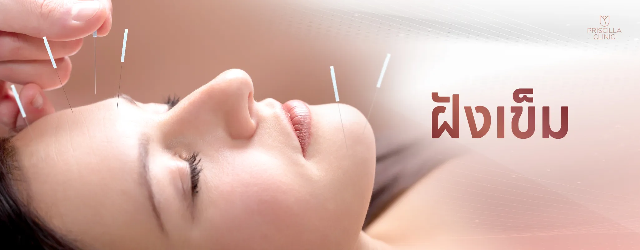 ฝังเข็ม1_result